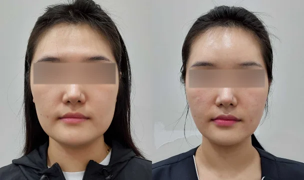 쥬베룩 볼륨 전후 — 동탄점