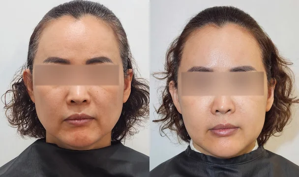 온다90kj 3회 전후 — 동탄점