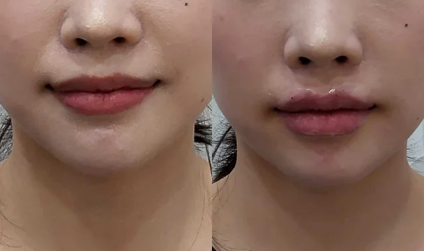 레나필 입술 필러 1cc+하이톡스 입꼬리 보톡스 전후 — 동탄점