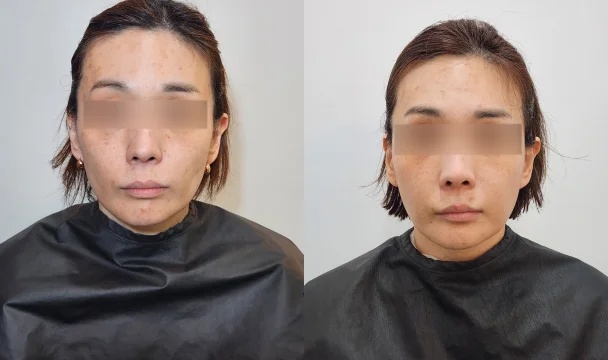 리볼브 3vial 2회 전후 — 동탄점