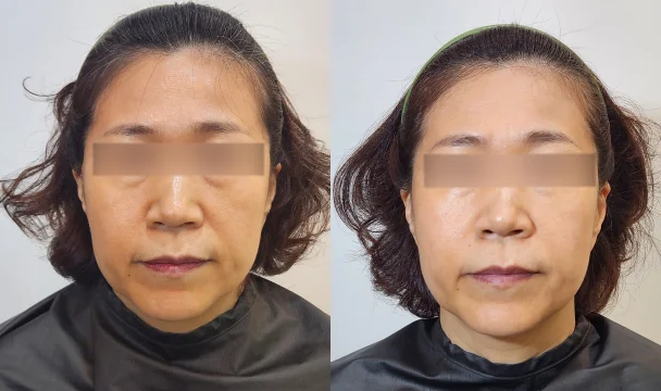 리볼르 15cc 전후 — 동탄점