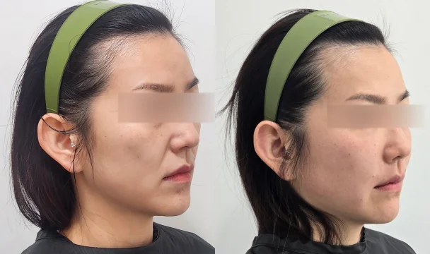 리볼르 15cc 전후 — 동탄점