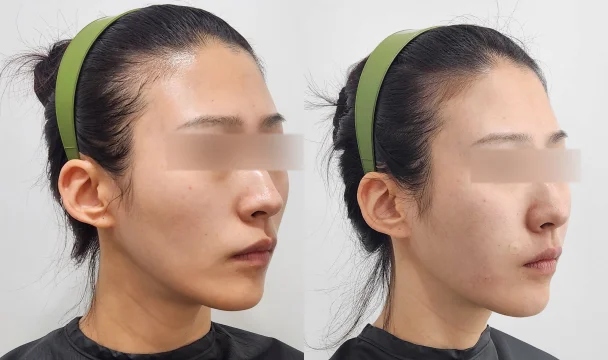 리볼르 15cc 전후 — 동탄점