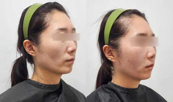 리볼르 3vial 전후 — 동탄점