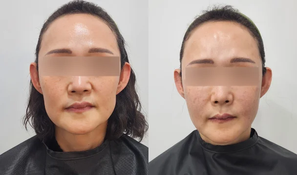 볼륨부스터 15cc 전후 — 동탄점