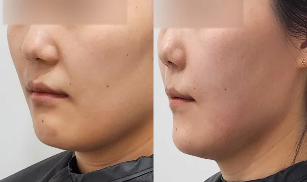 볼륨부스터 2vial 1회 전후 — 동탄점