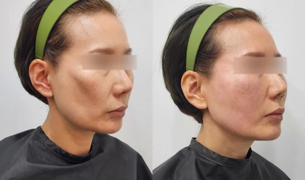 볼륨부스터 3vial 전후 — 동탄점