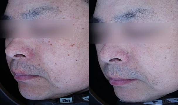 맞춤피코토닝 10회 전후 — 동탄점