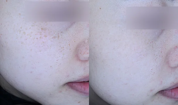 맞춤피코토닝 10회 전후 — 동탄점