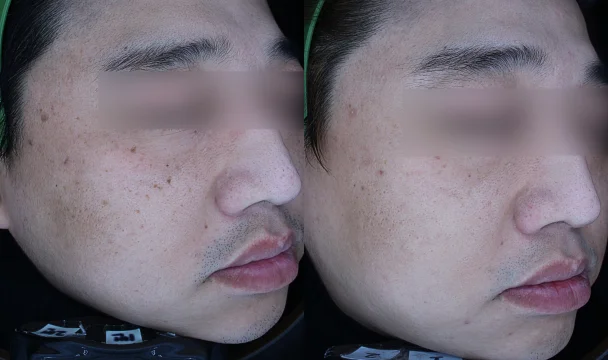 시그니처 물광피코토닝 8회 전후 — 동탄점