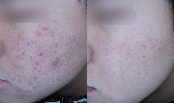 시그니처 프리미엄 아쿠아필 안티아크네 8회 전후 — 동탄점