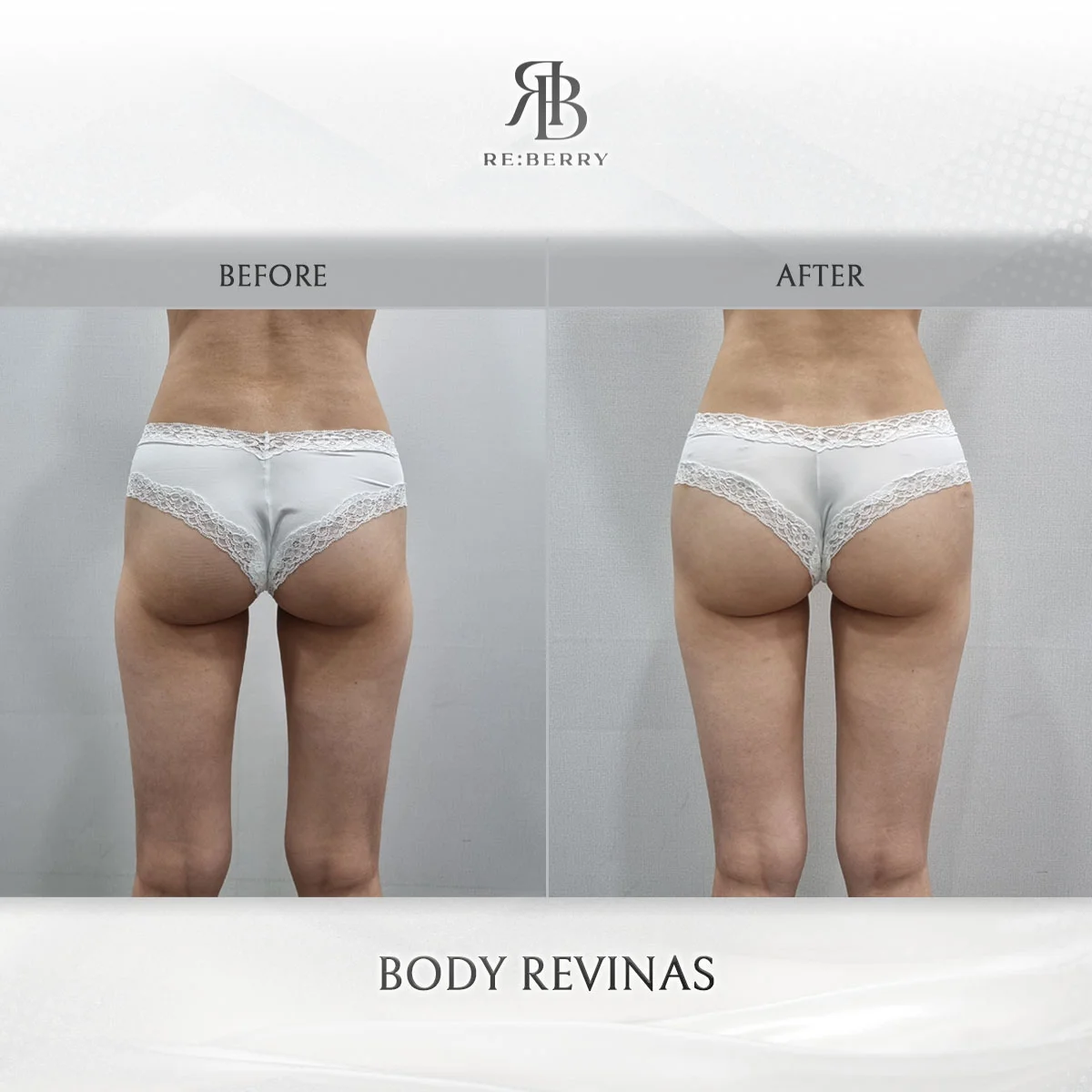 Before and after body treatment result at RE:BERRY Clinic Gangnam Seoul — real patient photo