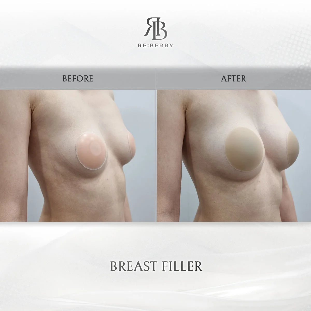 Before and after body treatment result at RE:BERRY Clinic Gangnam Seoul — real patient photo