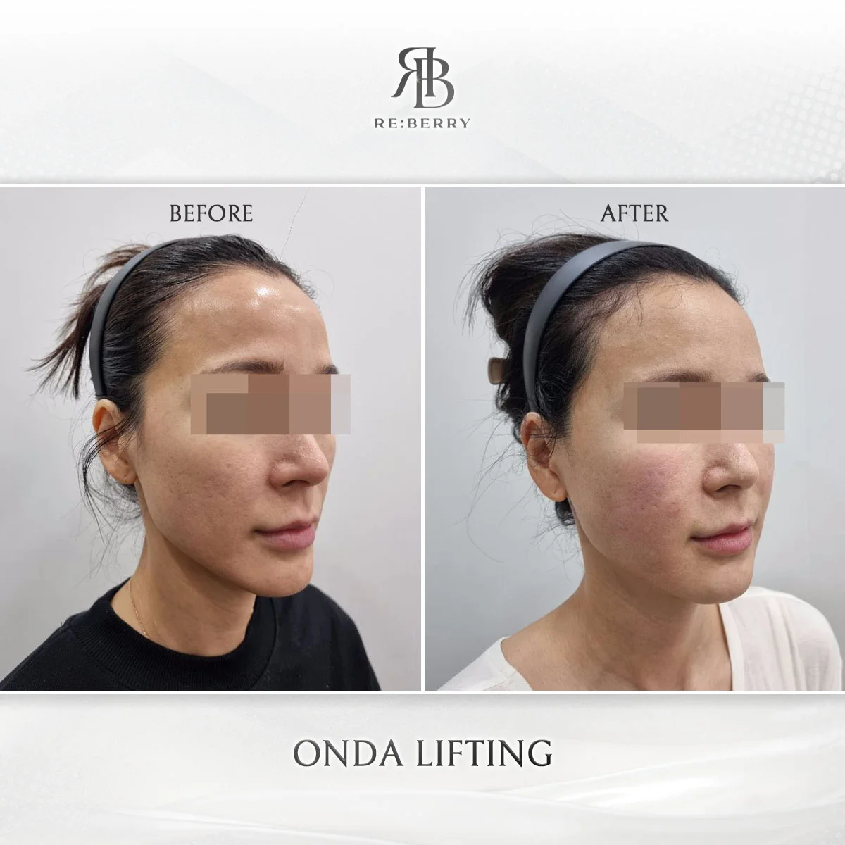 Before and after lifting treatment result at RE:BERRY Clinic Gangnam Seoul — real patient photo