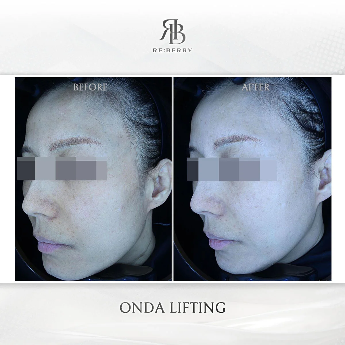 Before and after lifting treatment result at RE:BERRY Clinic Gangnam Seoul — real patient photo