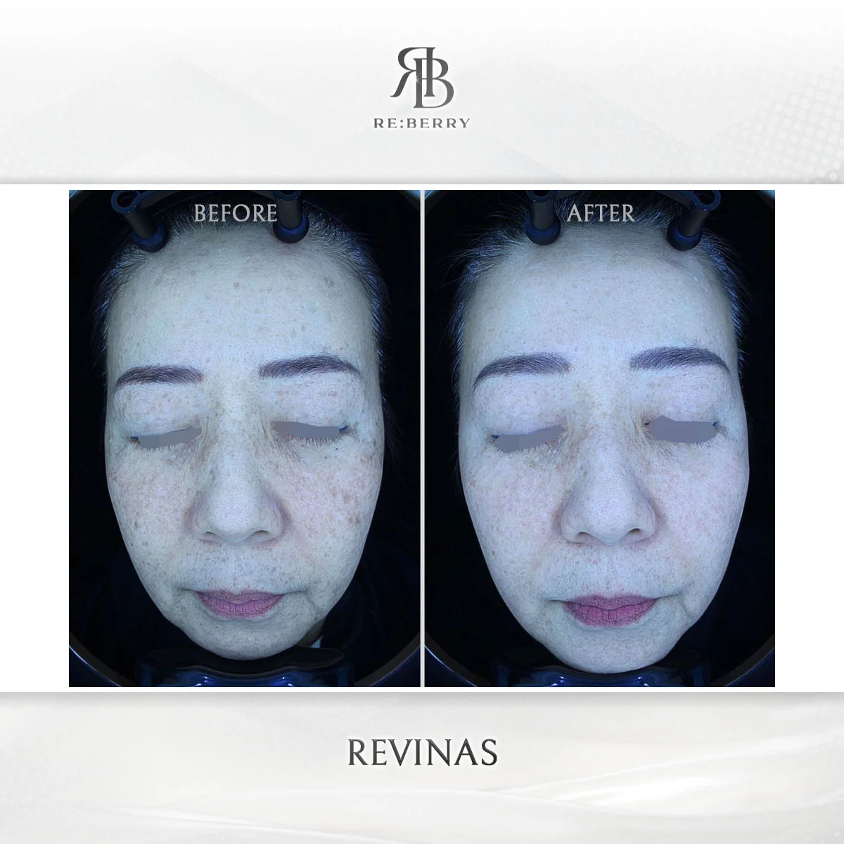 Before and after lifting treatment result at RE:BERRY Clinic Gangnam Seoul — real patient photo