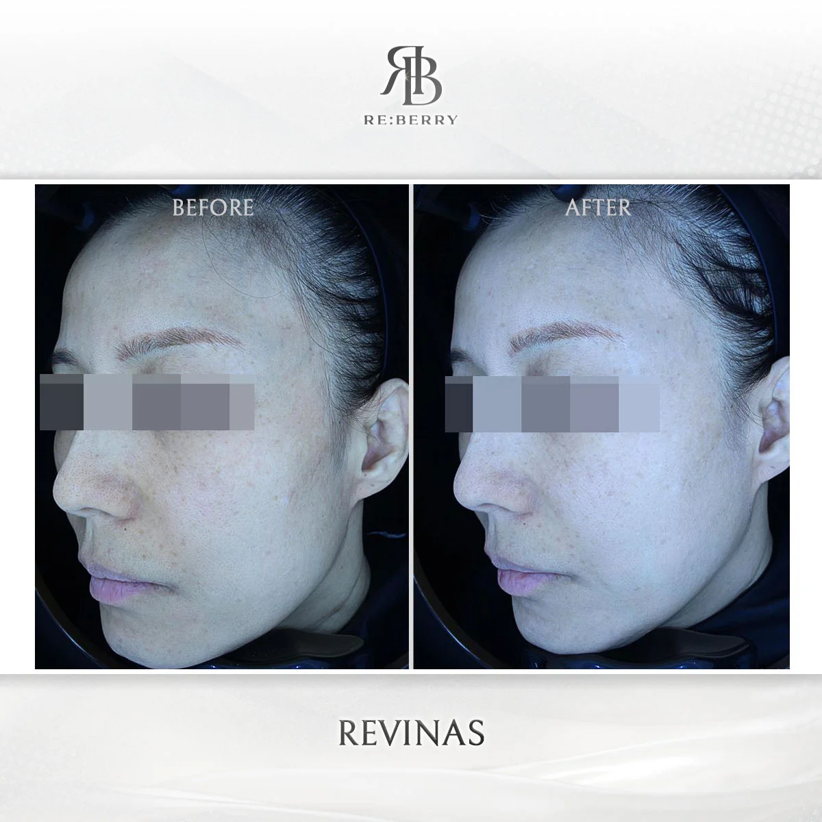 Before and after lifting treatment result at RE:BERRY Clinic Gangnam Seoul — real patient photo