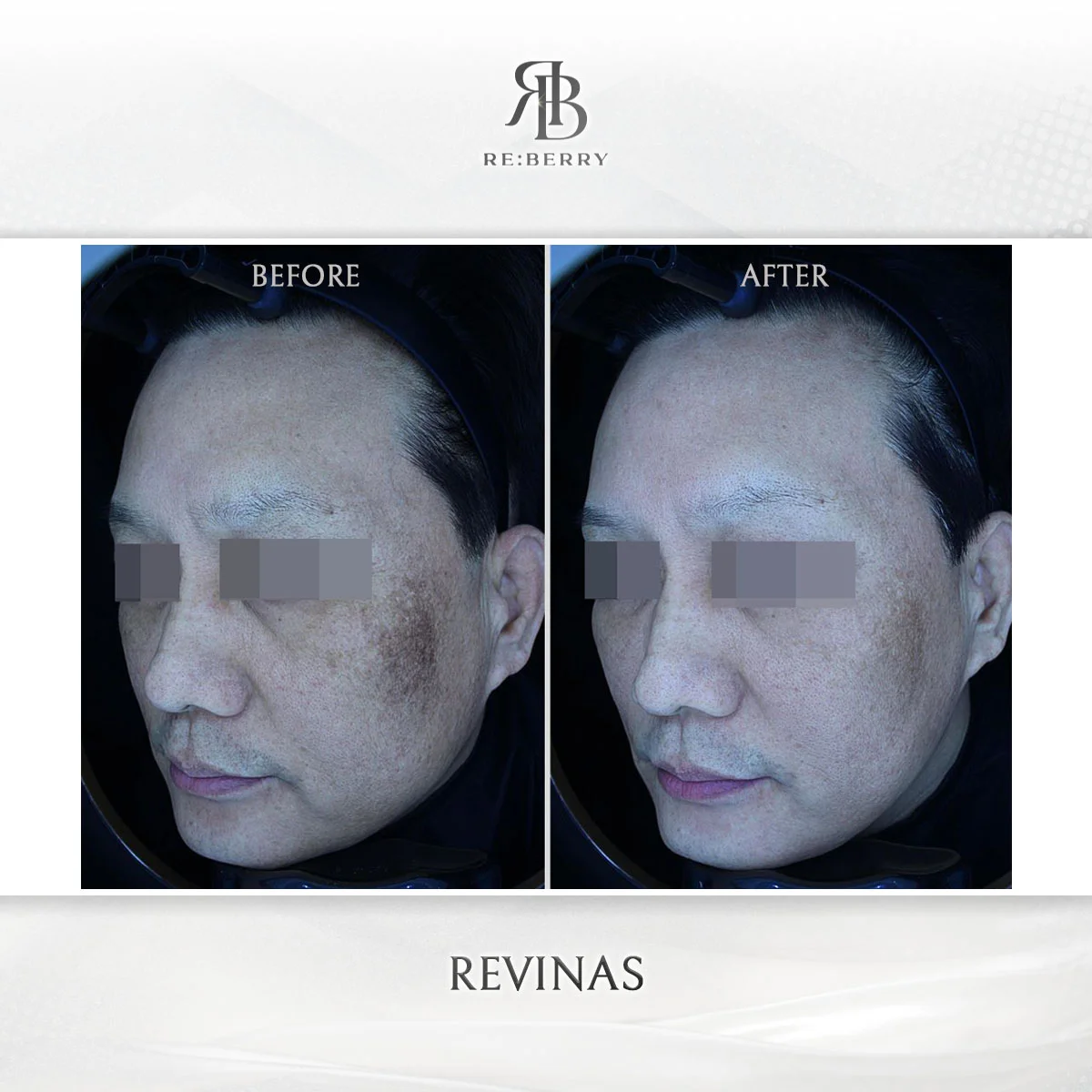 Before and after lifting treatment result at RE:BERRY Clinic Gangnam Seoul — real patient photo