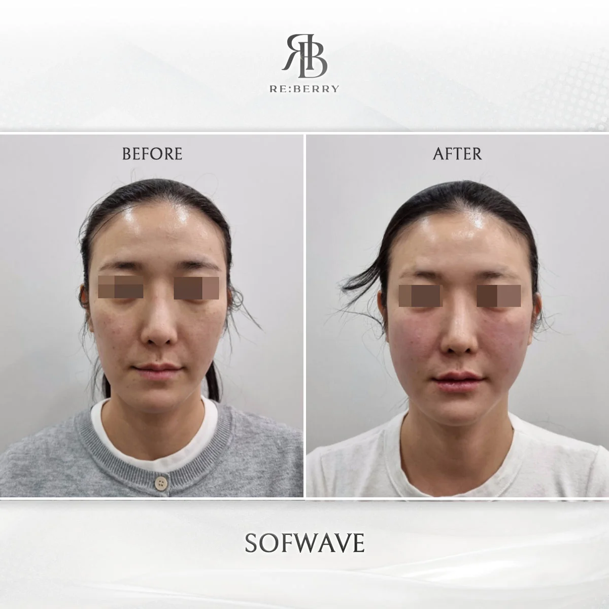 Before and after lifting treatment result at RE:BERRY Clinic Gangnam Seoul — real patient photo