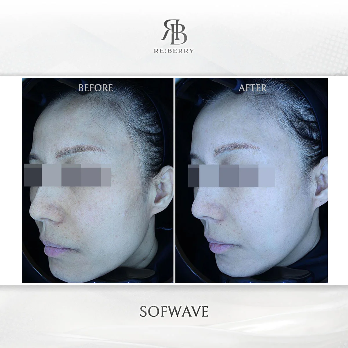 Before and after lifting treatment result at RE:BERRY Clinic Gangnam Seoul — real patient photo