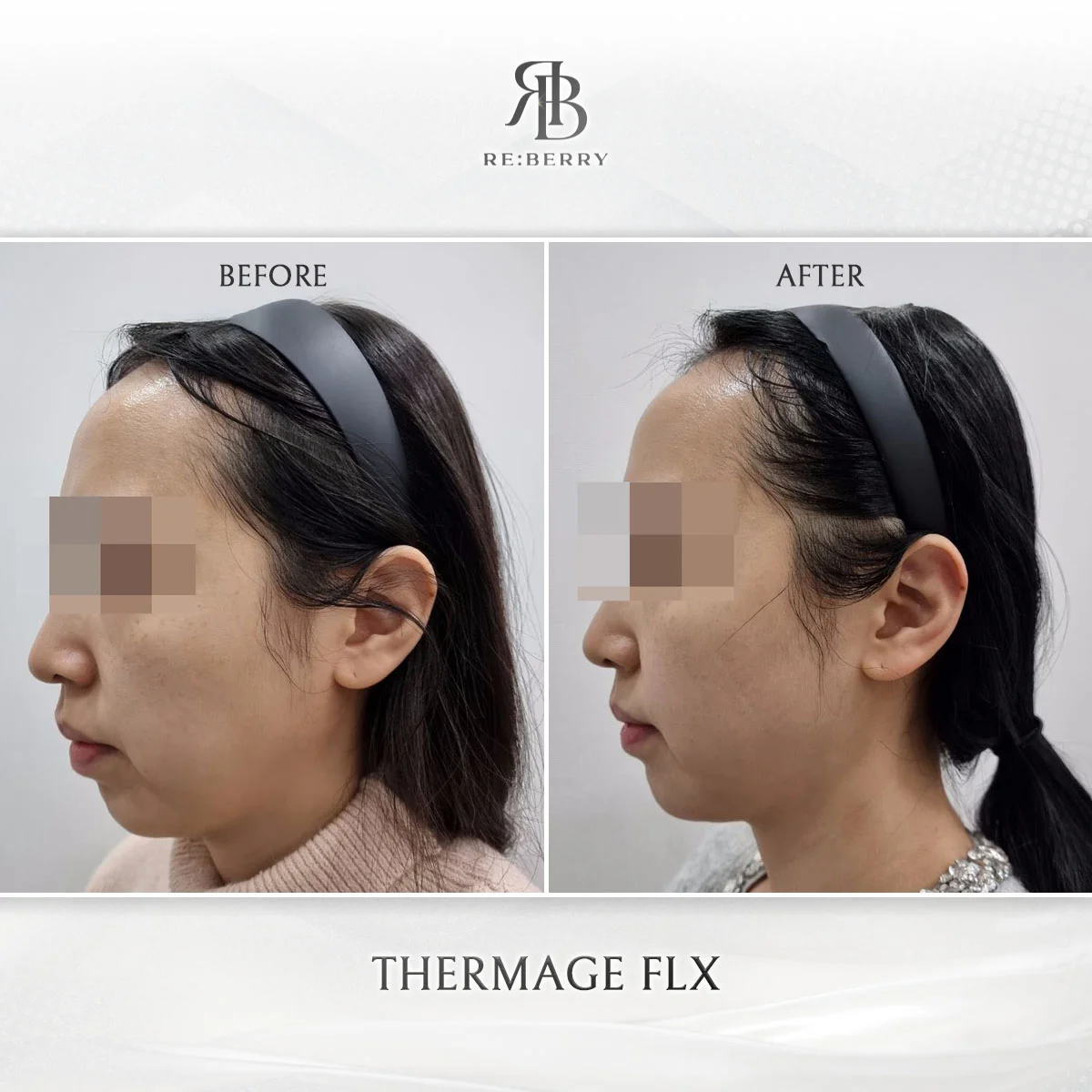 Before and after lifting treatment result at RE:BERRY Clinic Gangnam Seoul — real patient photo