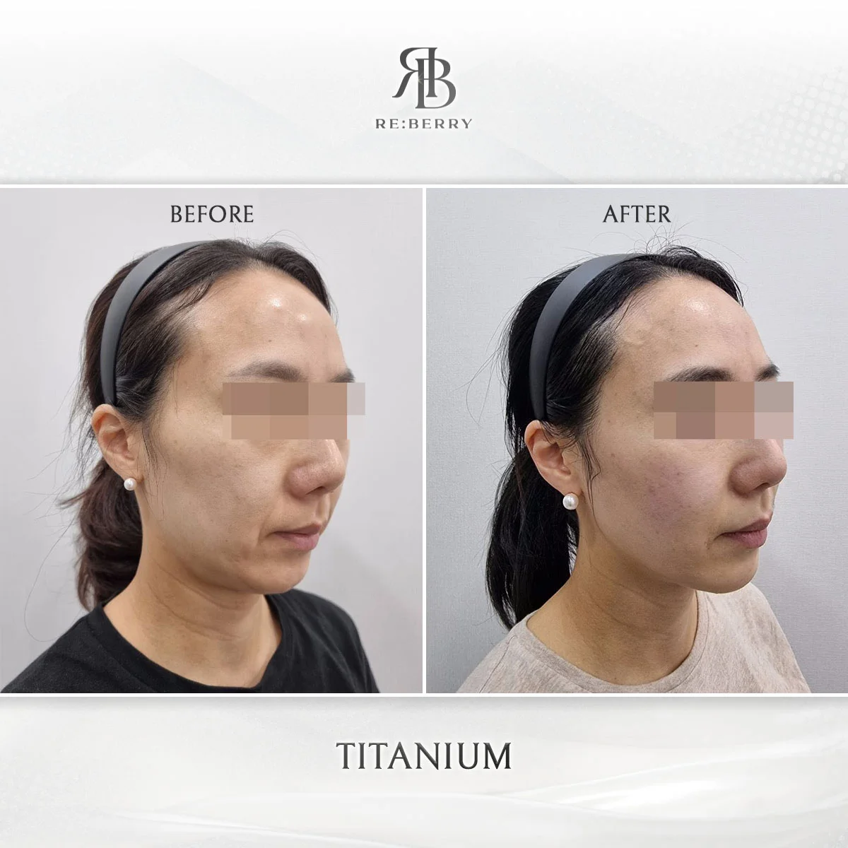 Before and after lifting treatment result at RE:BERRY Clinic Gangnam Seoul — real patient photo