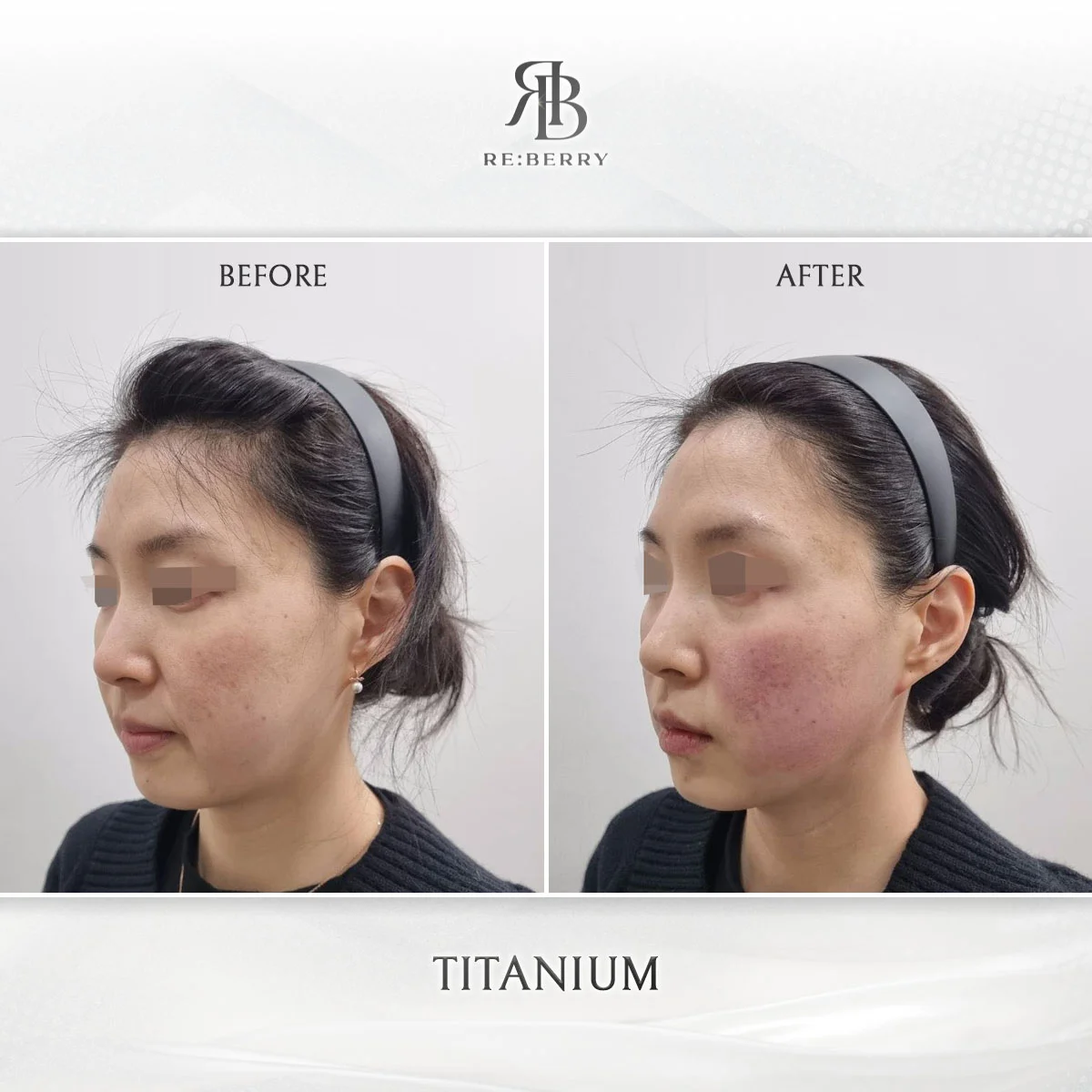 Before and after lifting treatment result at RE:BERRY Clinic Gangnam Seoul — real patient photo