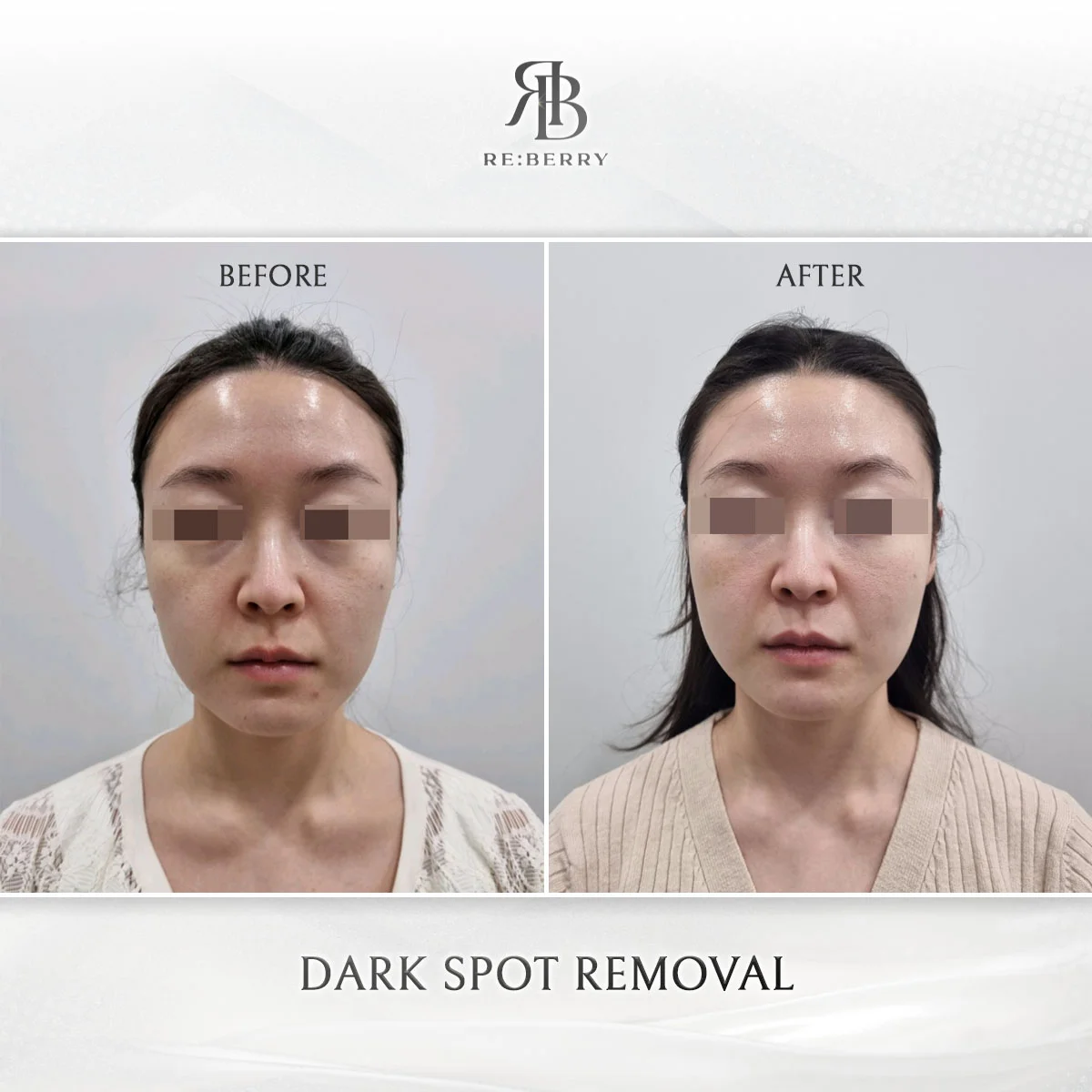 Before and after skin & laser treatment result at RE:BERRY Clinic Gangnam Seoul — real patient photo