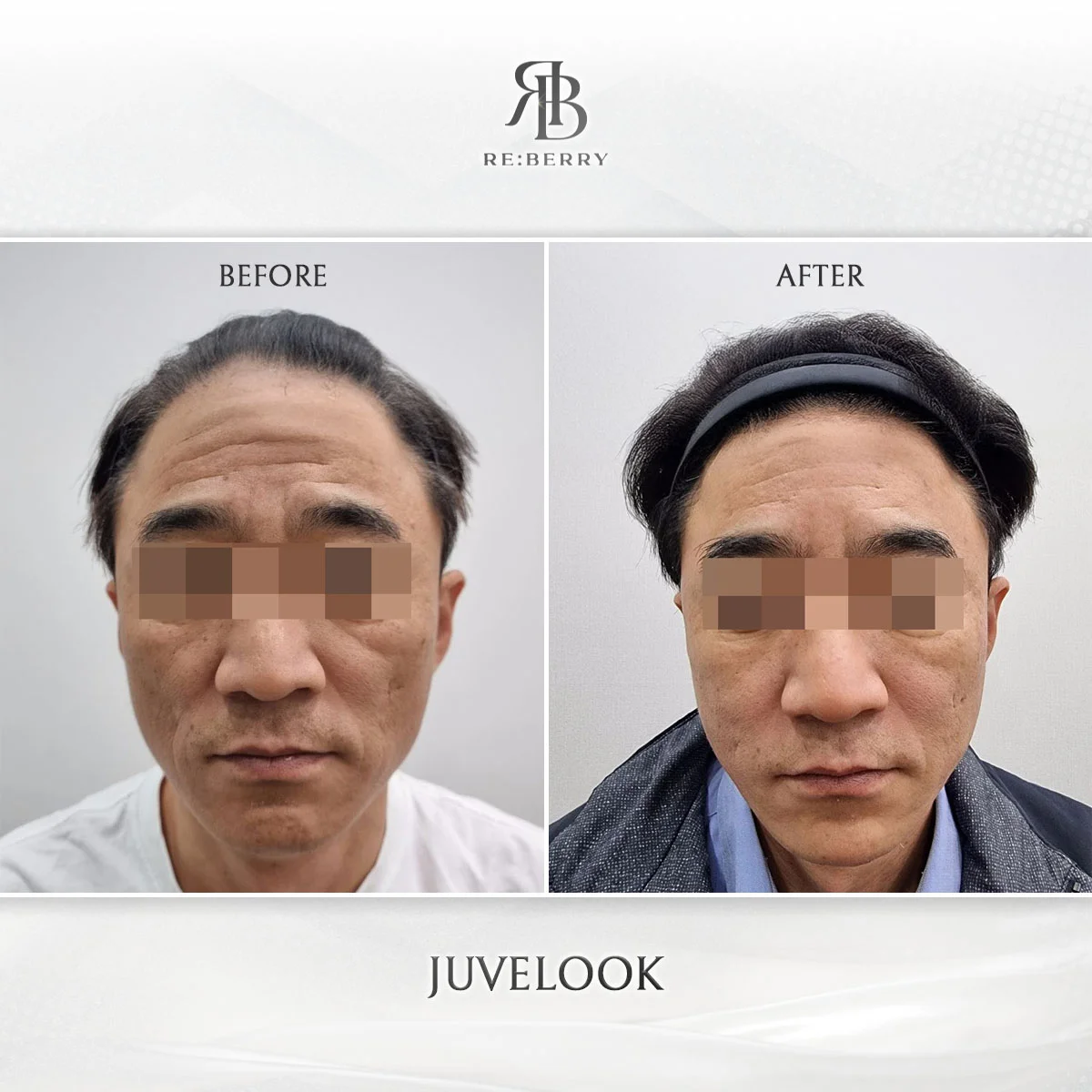 Before and after skin & laser treatment result at RE:BERRY Clinic Gangnam Seoul — real patient photo