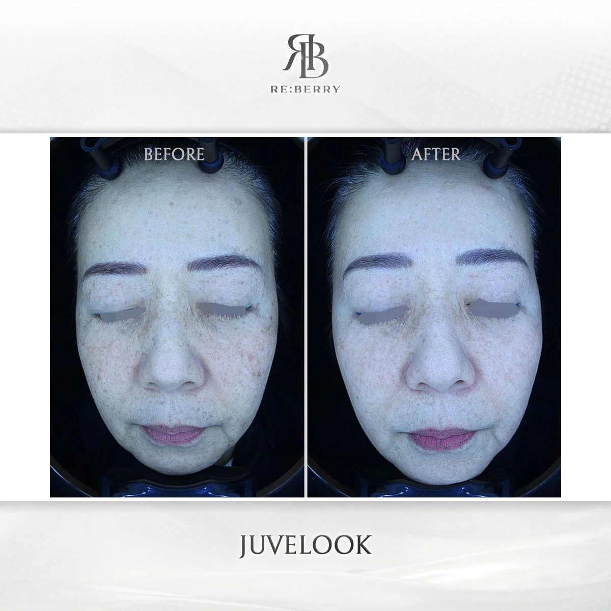 Before and after skin & laser treatment result at RE:BERRY Clinic Gangnam Seoul — real patient photo