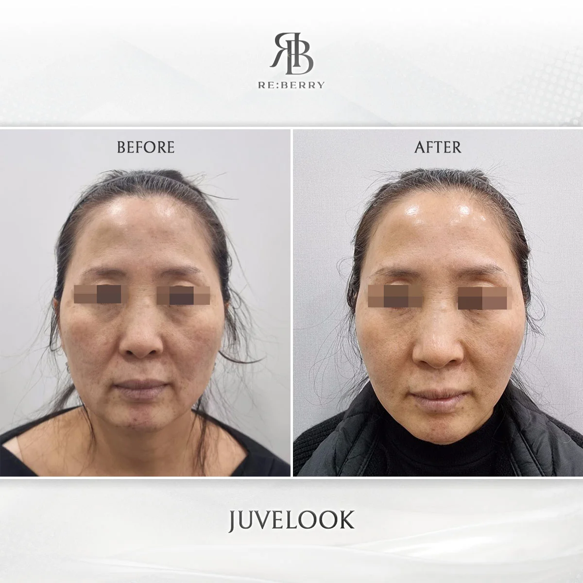 Before and after skin & laser treatment result at RE:BERRY Clinic Gangnam Seoul — real patient photo