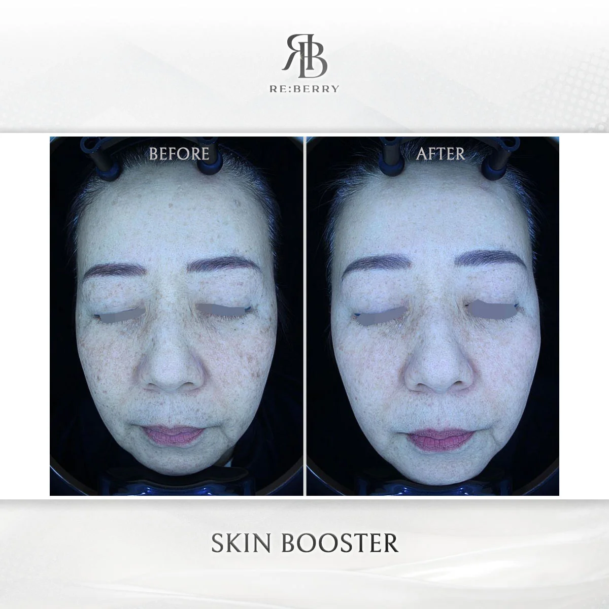 Before and after skin & laser treatment result at RE:BERRY Clinic Gangnam Seoul — real patient photo