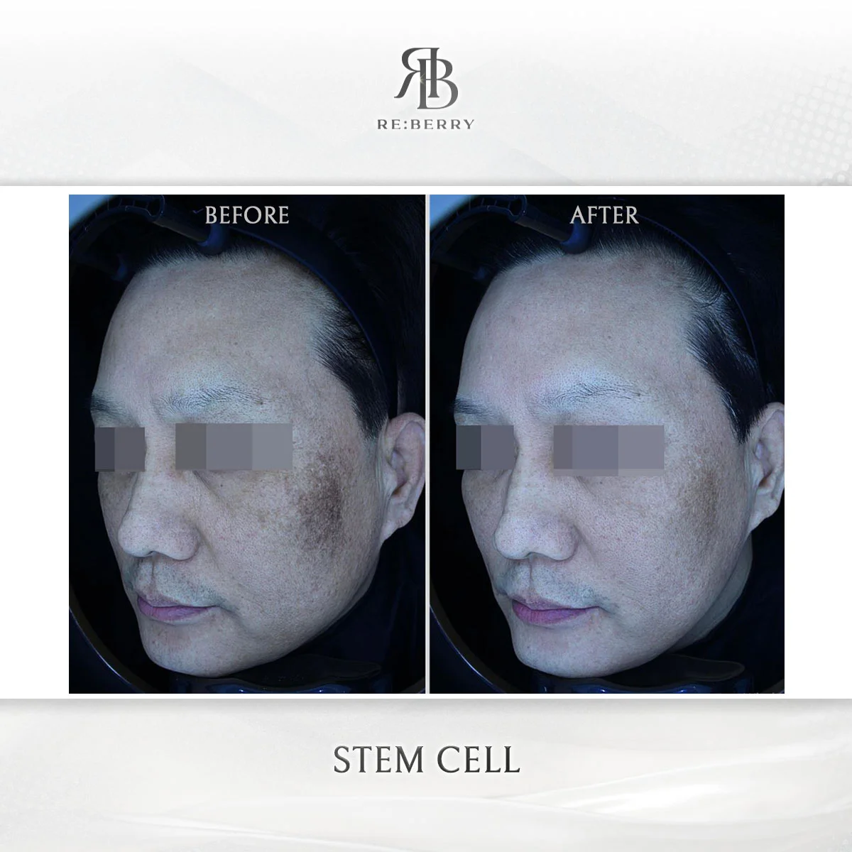 Before and after stem cell treatment result at RE:BERRY Clinic Gangnam Seoul — real patient photo