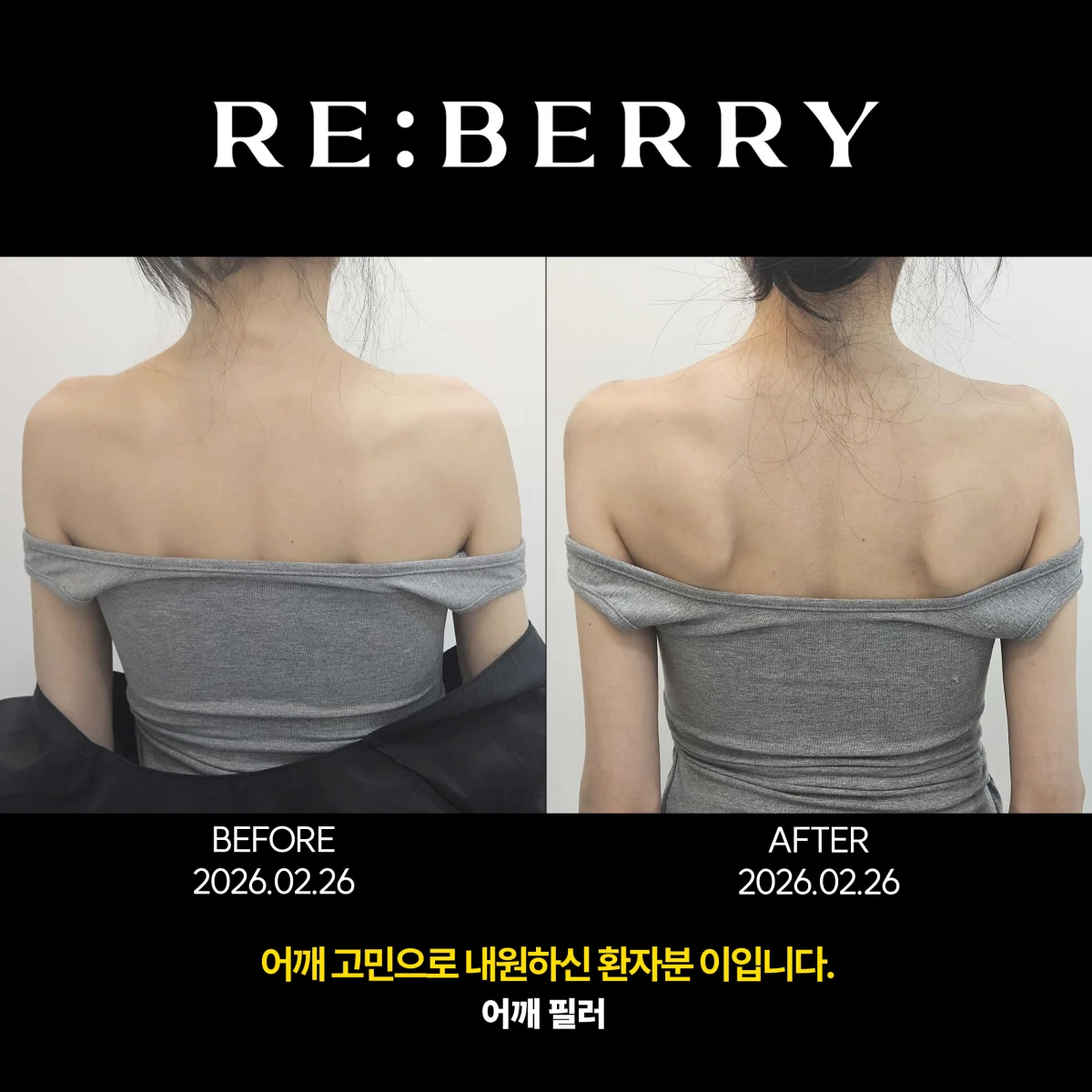 Before and after volume & filler treatment result at RE:BERRY Clinic Gangnam Seoul — real patient photo