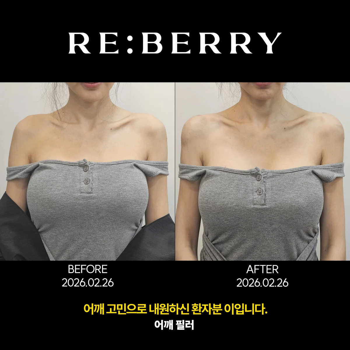 Before and after volume & filler treatment result at RE:BERRY Clinic Gangnam Seoul — real patient photo