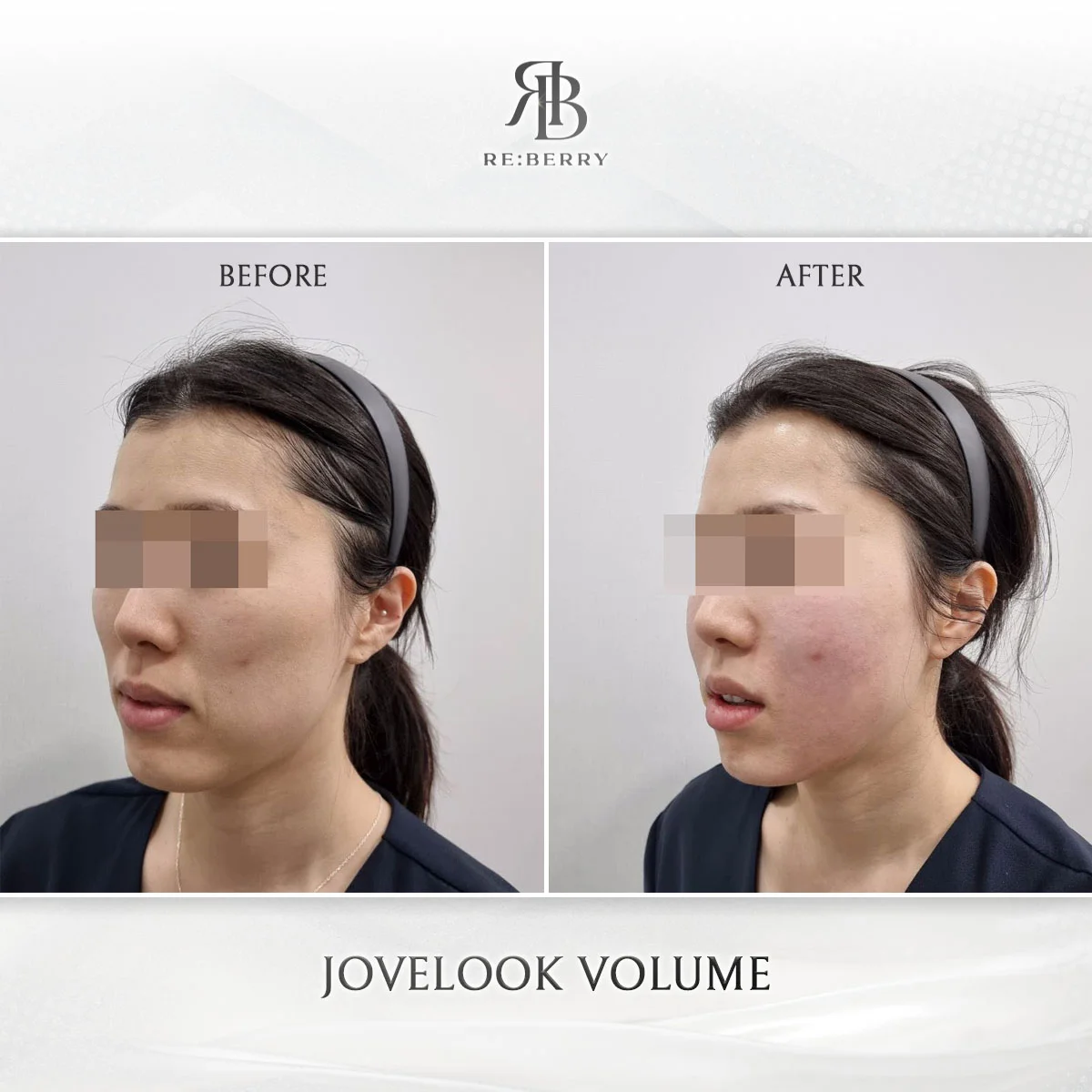 Before and after volume & filler treatment result at RE:BERRY Clinic Gangnam Seoul — real patient photo