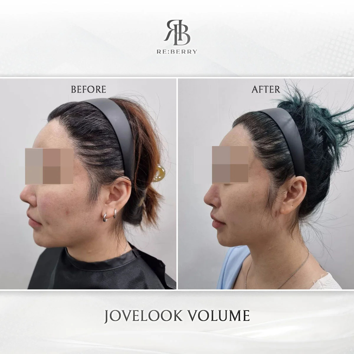 Before and after volume & filler treatment result at RE:BERRY Clinic Gangnam Seoul — real patient photo