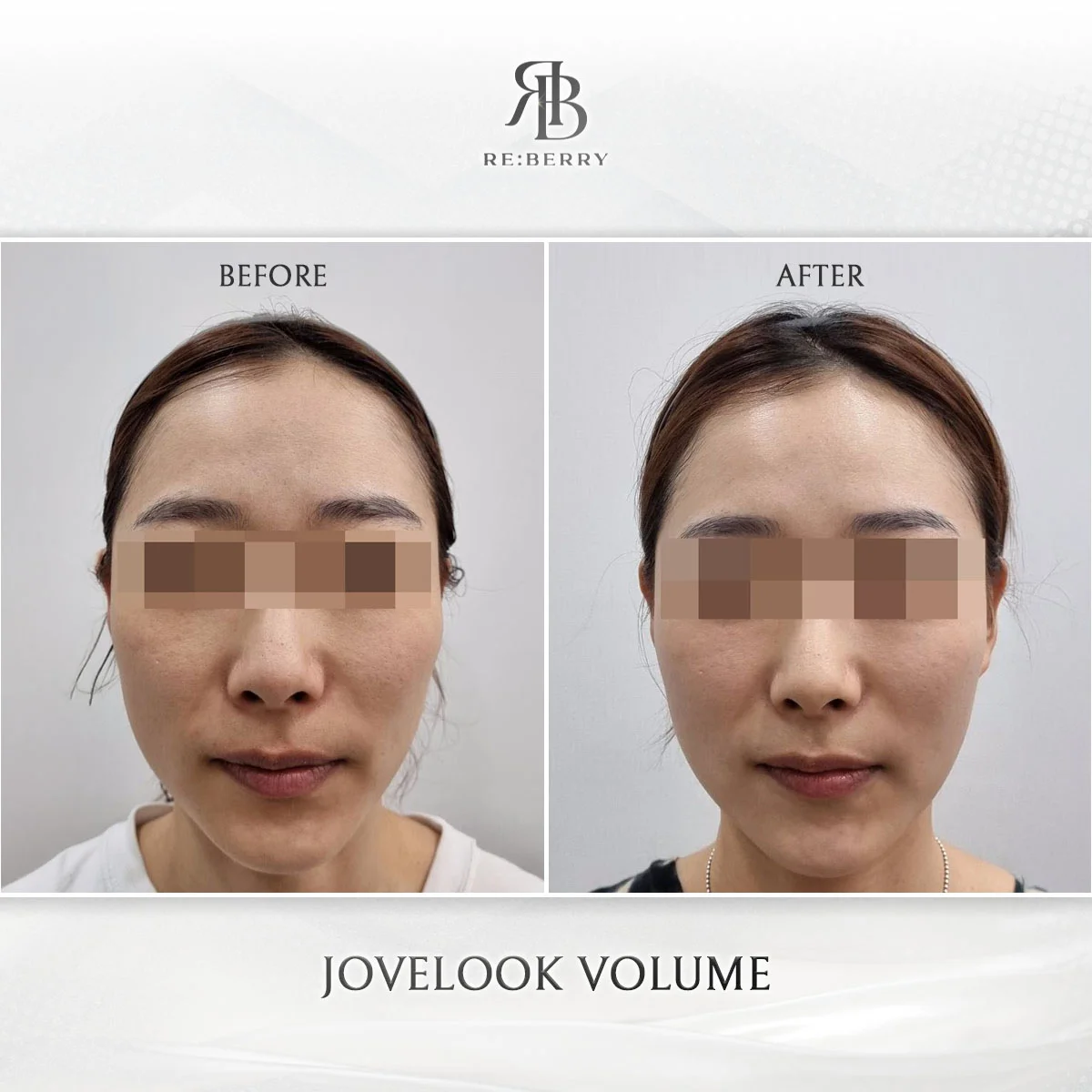 Before and after volume & filler treatment result at RE:BERRY Clinic Gangnam Seoul — real patient photo