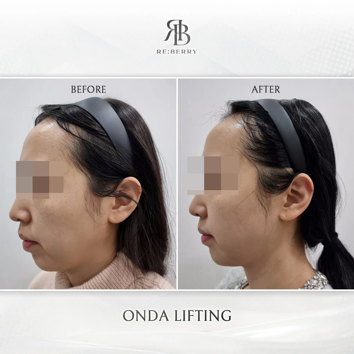 Before and after lifting treatment result at RE:BERRY clinic Seoul — real patient photo