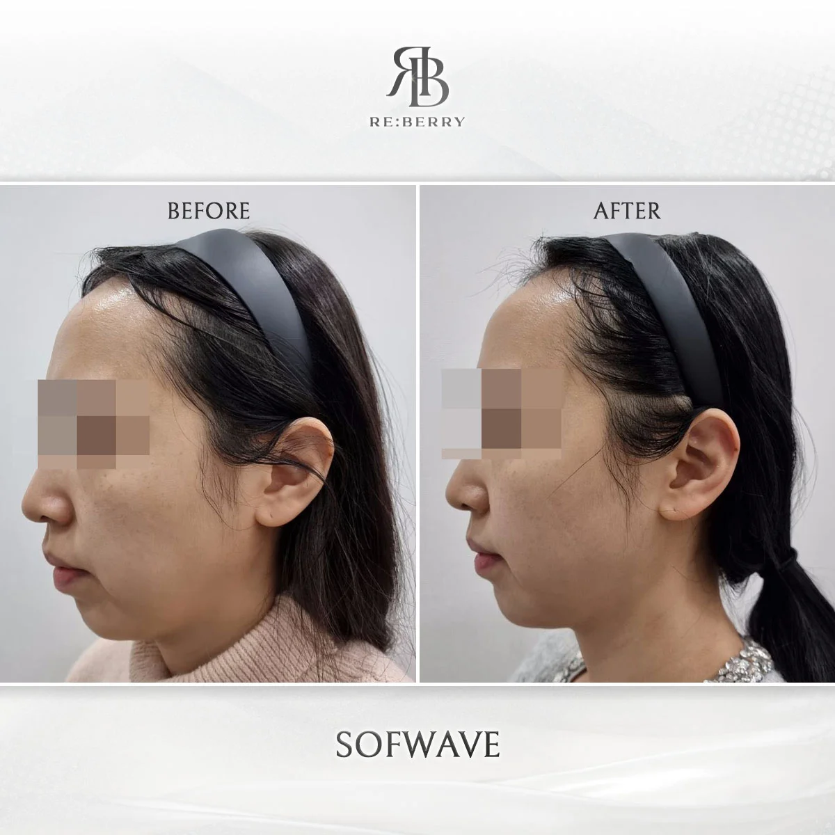 Before and after lifting treatment result at RE:BERRY clinic Seoul — real patient photo