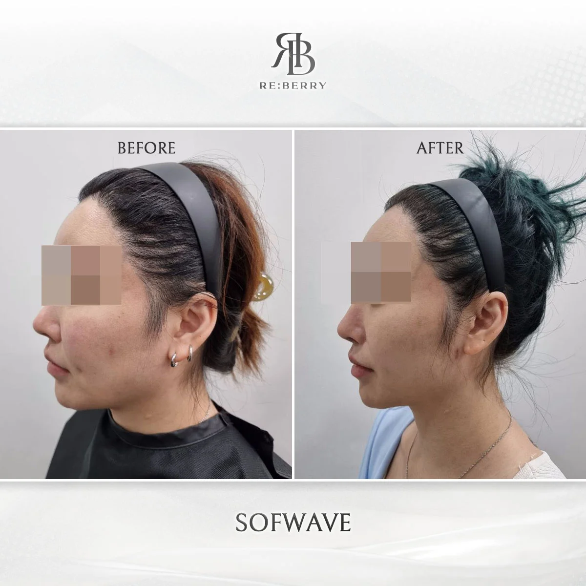 Before and after lifting treatment result at RE:BERRY clinic Seoul — real patient photo