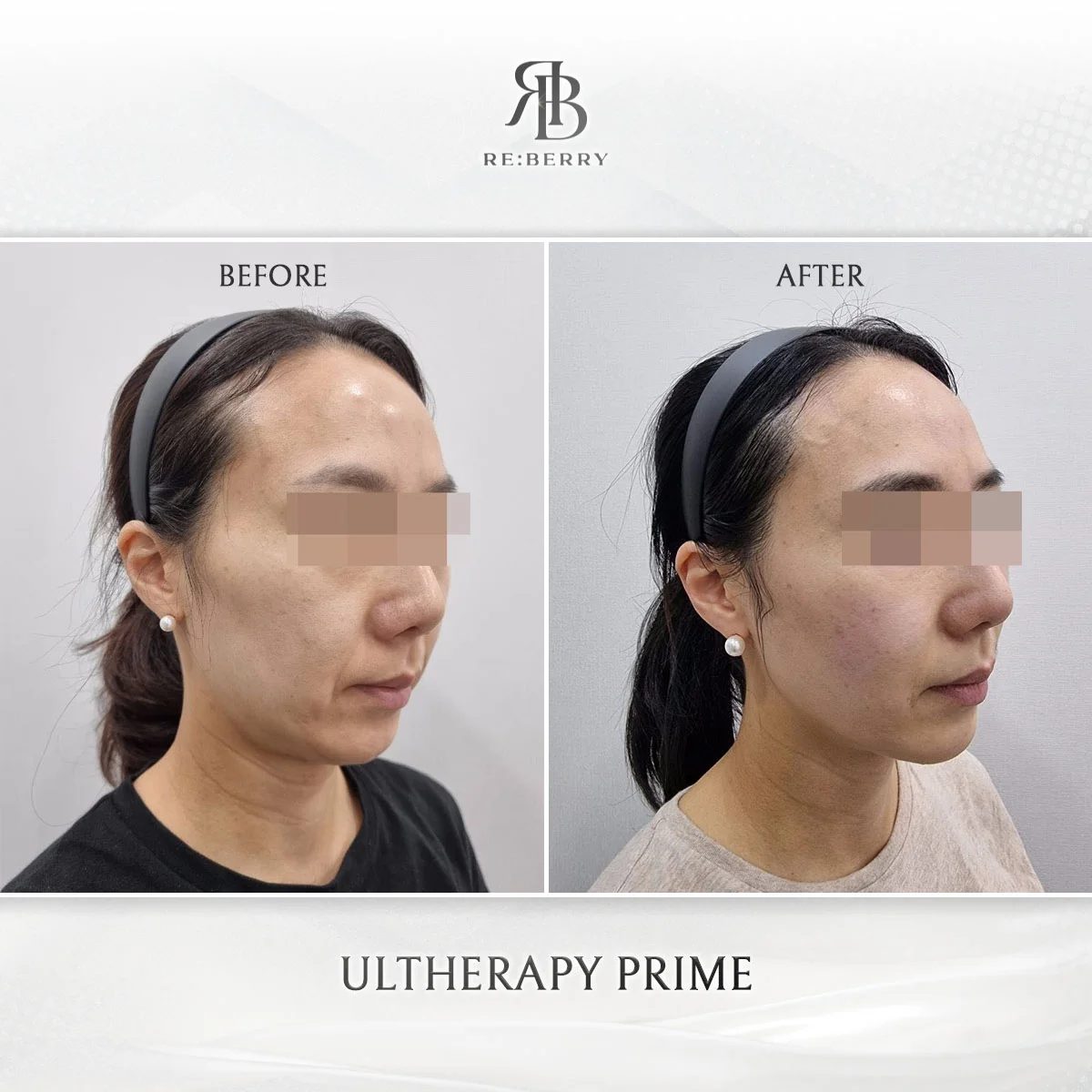 Before and after lifting treatment result at RE:BERRY clinic Seoul — real patient photo