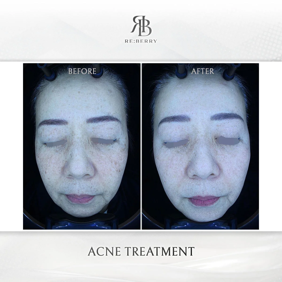 Skin treatment — before & after at RE:BERRY