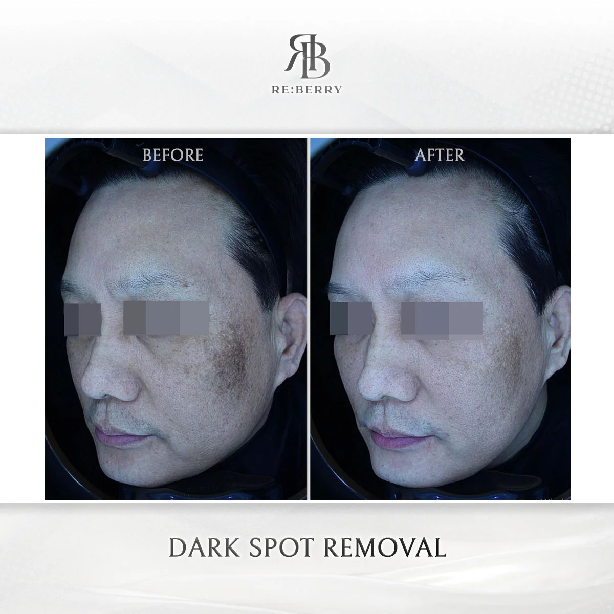 Skin treatment — before & after at RE:BERRY