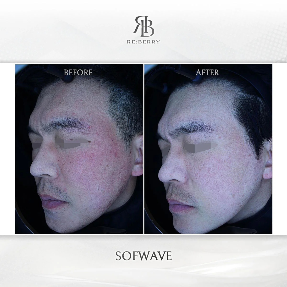 Skin treatment — before & after at RE:BERRY