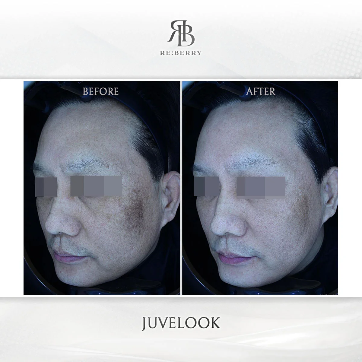 Skin treatment — before & after at RE:BERRY
