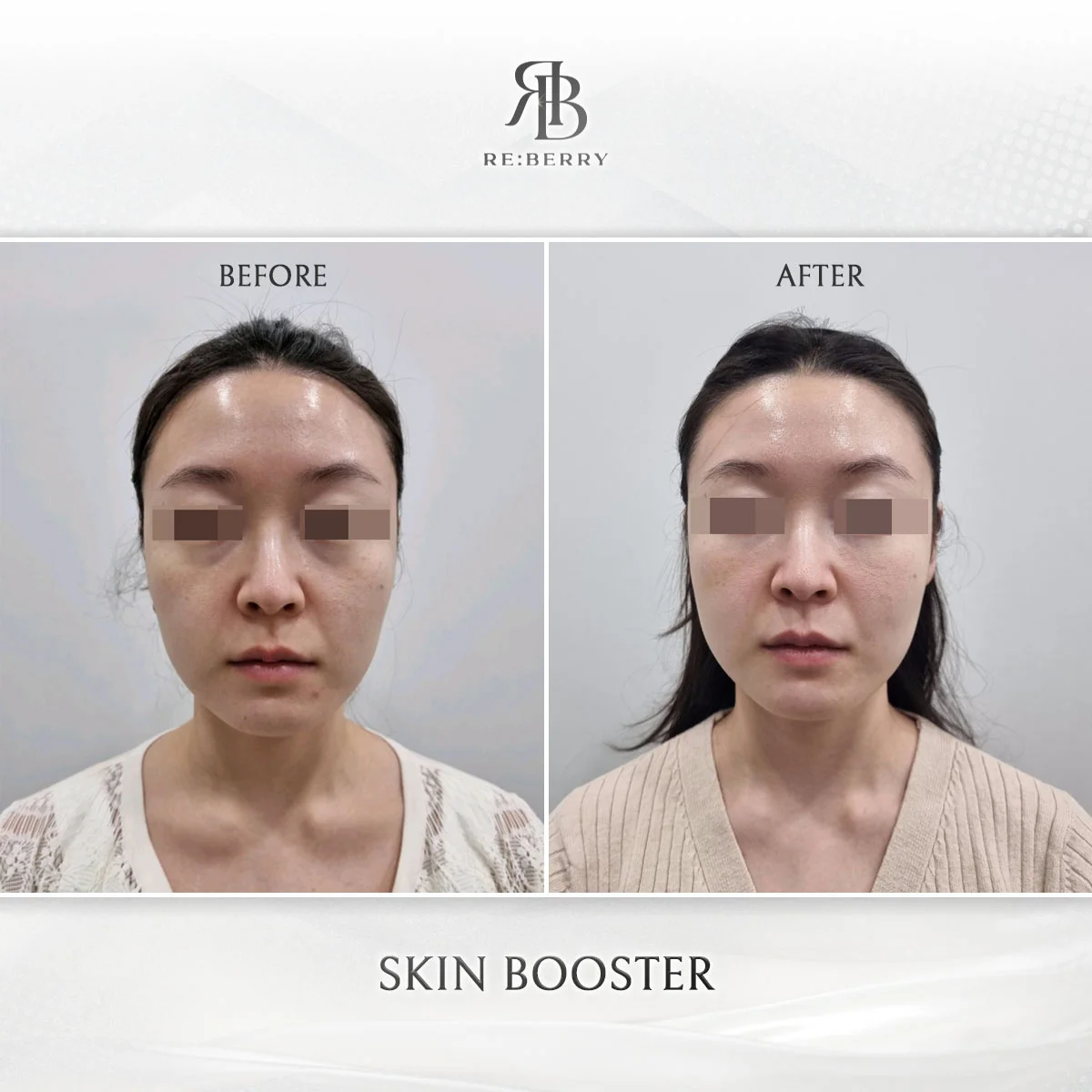 Skin treatment — before & after at RE:BERRY