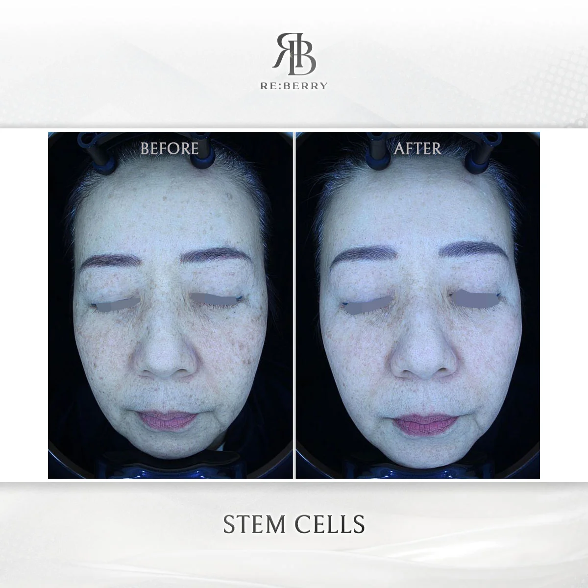 Regenerative treatment — before & after at RE:BERRY