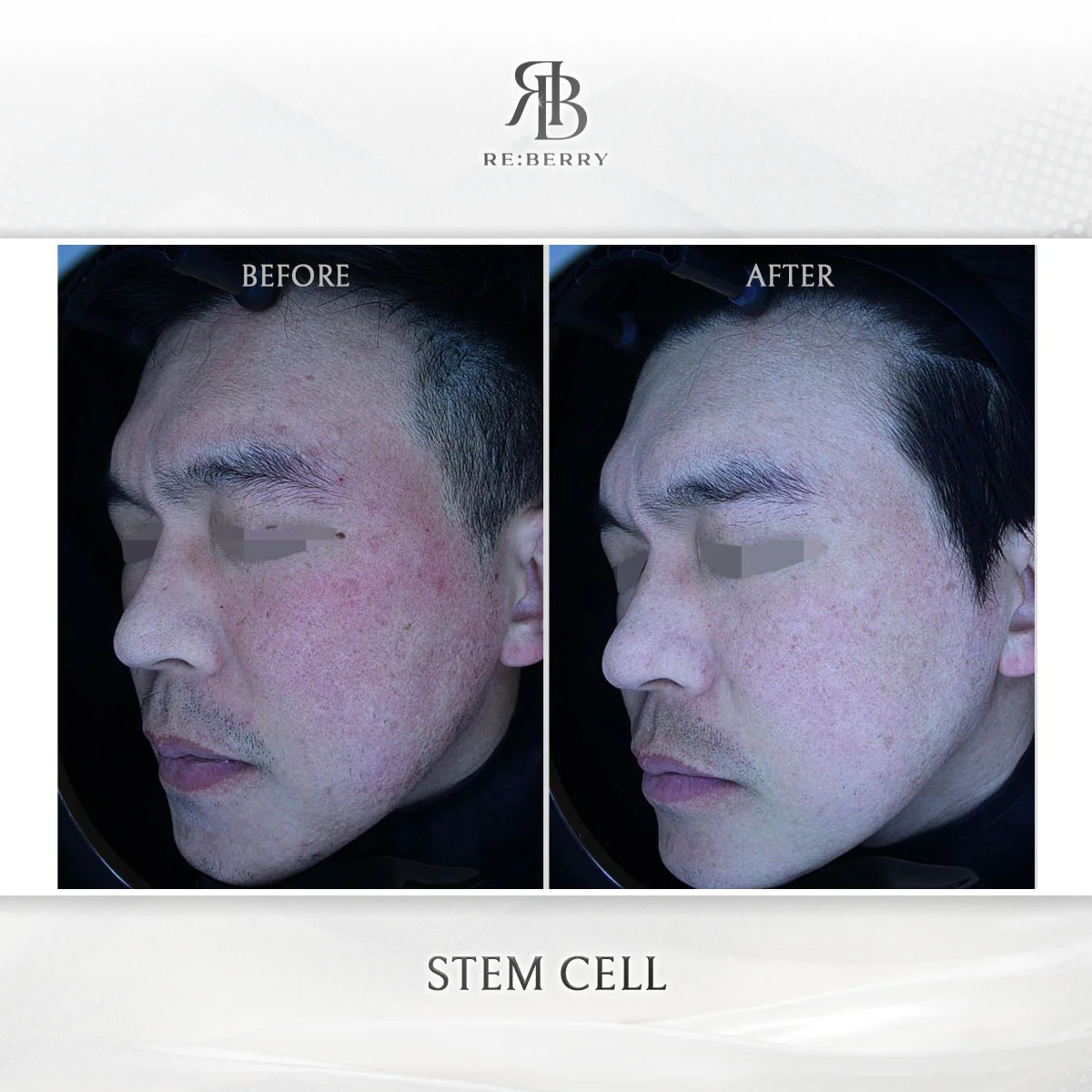 Regenerative treatment — before & after at RE:BERRY