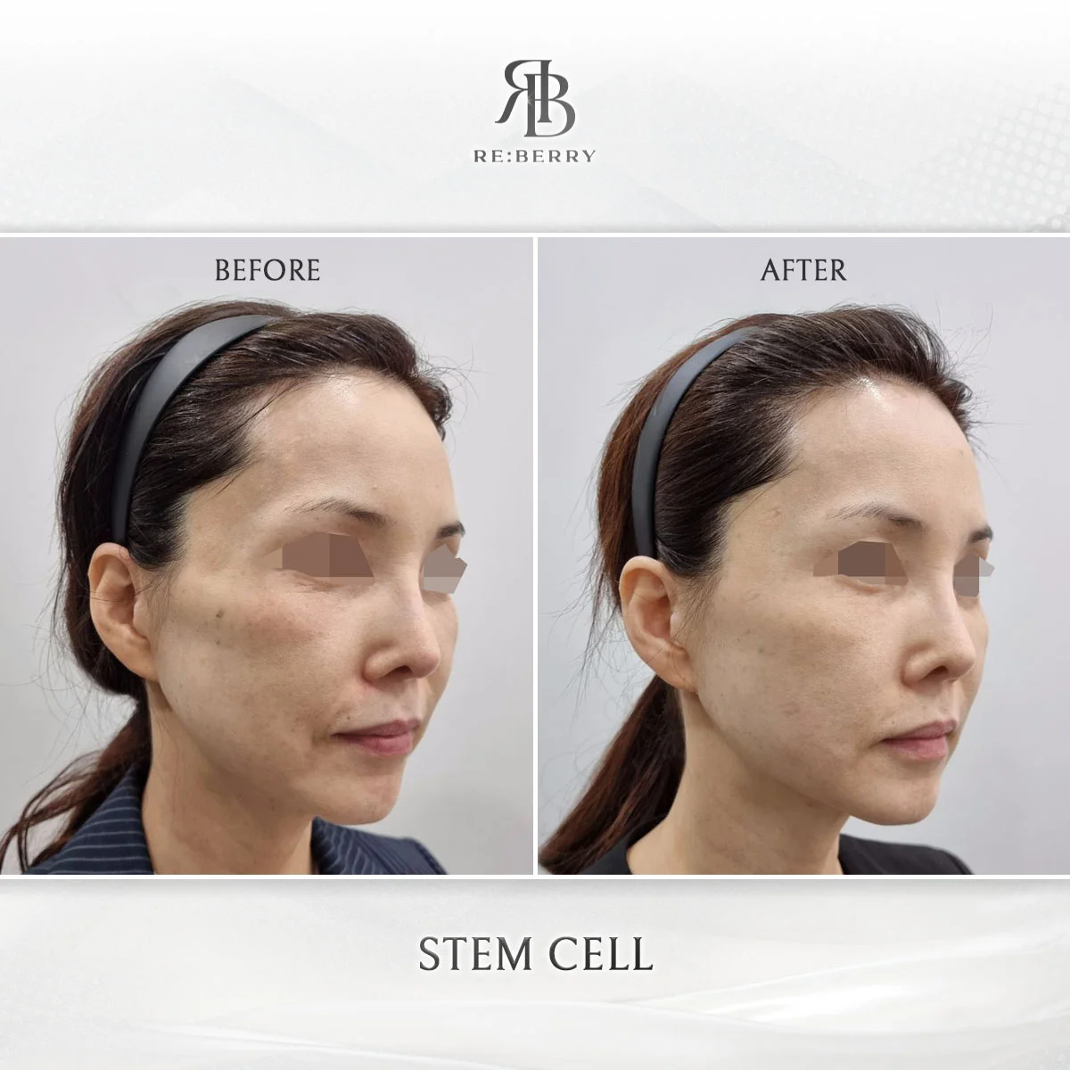 Regenerative treatment — before & after at RE:BERRY